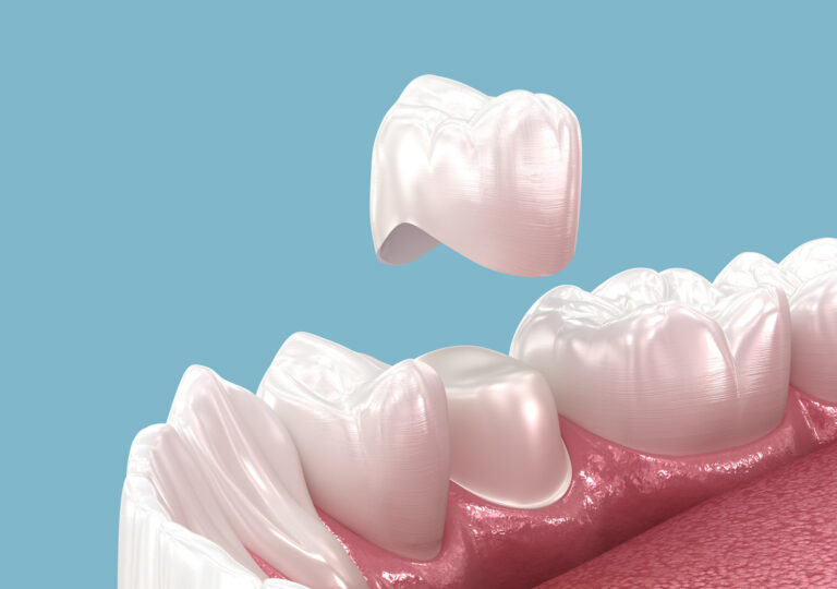 The image illustrates a dental crown placement, showing a prepared tooth with surrounding gums and adjacent teeth. The shiny white crown is positioned above the tooth, demonstrating a restorative procedure to enhance functionality and aesthetics.